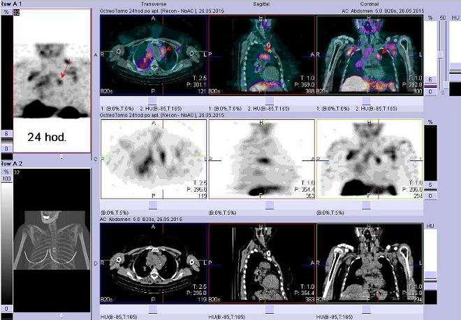 Obr. . 7: Fze obraz SPECT a CT  vyeten hrudnku a krku. Vyeten 24 hod. po aplikaci radiofarmaka. Nahoe fze obraz, uprosted SPECT, dole CT. Vdy nad sebou: vlevo transverzln ezy, uprosted sagitln, vpravo koronrn. Zameno na uzliny v levm plicnm hilu.