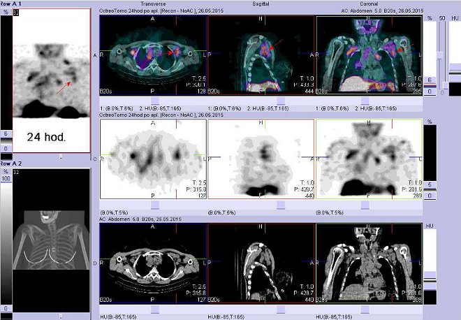 Obr. . 8: Fze obraz SPECT a CT  vyeten hrudnku a krku. Vyeten 24 hod. po aplikaci radiofarmaka. Nahoe fze obraz, uprosted SPECT, dole CT. Vdy nad sebou: vlevo transverzln ezy, uprosted sagitln, vpravo koronrn. Zameno na uzliny v lev axile.