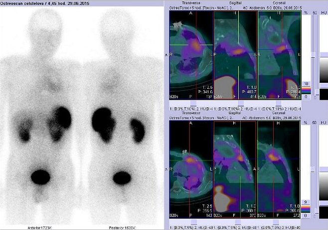 Obr.3: Celotlov scintigrafie a fze obraz SPECT a CT  vyeten hrudnku. Vyeten 4 hod. po aplikaci radiofarmaka. Vdy nad sebou: vlevo transverzln ezy, uprosted sagitln ezy, vpravo koronrn. Vpravo nahoe i dole zameno na loisko vlev plci.