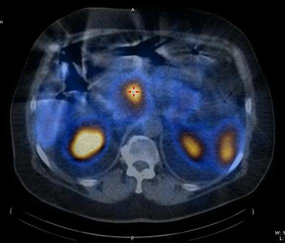 Obr. 1a: Tumor hlavy pankreatu s vysokou hustotu somatostatinovch receptor  ez axiln.