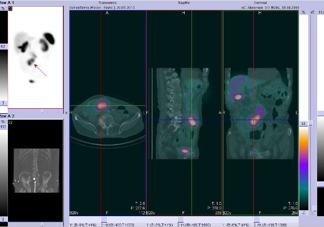 Obr..3: Fze obraz SPECT a CT  bicho, pnev. Vyeten 24 hod. po aplikaci radiofarmaka. Zameno na vysoce aktivn loisko ve stedn e v mesogastriu ventrln.