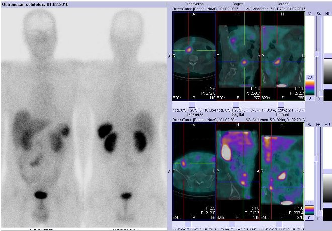 Obr.1: Celotlov scintigrafie a fze obraz SPECT a CT. Vpravo nahoe zameno na loisko v pravm mesogastriu v blzkosti stedn ry a vpravo dole na loisko v pravm hypogastriu ve stev. ez transverzln, sagitln a koronrn. Vyeten 4 hod. po aplikaci OctreoScanu.