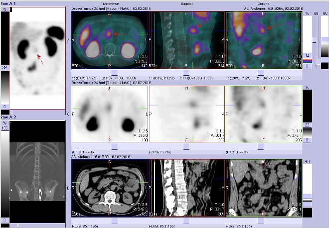 Obr.3: Fze obraz SPECT a CT. Zameno na loisko v epigastriu vpravo v blzkosti stedn ry. Nahoe fze obraz, uprosted SPECT, dole CT. ezy transverzln, sagitln a koronrn. Vyeten 24 hod. po aplikaci OctreoScanu.