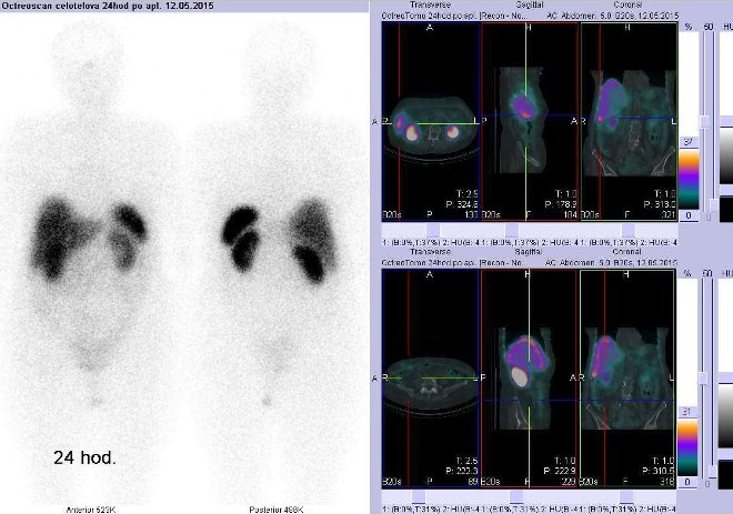 Obr. . 6: Celotlov scintigrafie v pedn a zadn projekci a fze SPECT/CT 24 hod. po aplikaci OctreoScanu. Zameno na doln st pravho jaternho laloku (vpravo nahoe) a na prav mesogastrium (vpravo dole).