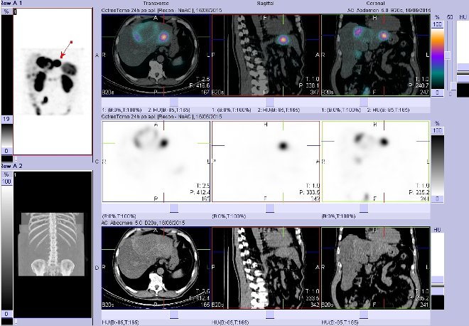 Obr. . 11: Fze obraz SPECT a CT  vyeten bicha. Vyeten 24 hod. po aplikaci radiofarmaka. Vpravo nahoe fze SPECT a CT, vlevo uprosted SPECT, vlevo dole CT. Zameno na loisko v levm jaternm laloku.
