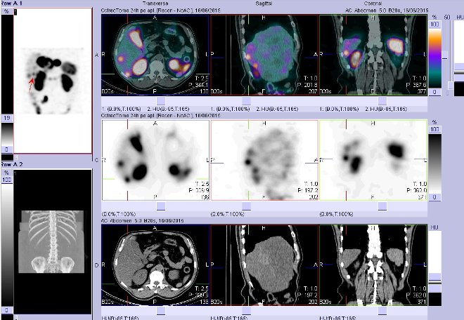 Obr. . 13: Fze obraz SPECT a CT  vyeten bicha. Vyeten 24 hod. po aplikaci radiofarmaka. Vpravo nahoe fze SPECT a CT, vlevo uprosted SPECT, vlevo dole CT. Zameno na loisko vpravm jaternm laloku.