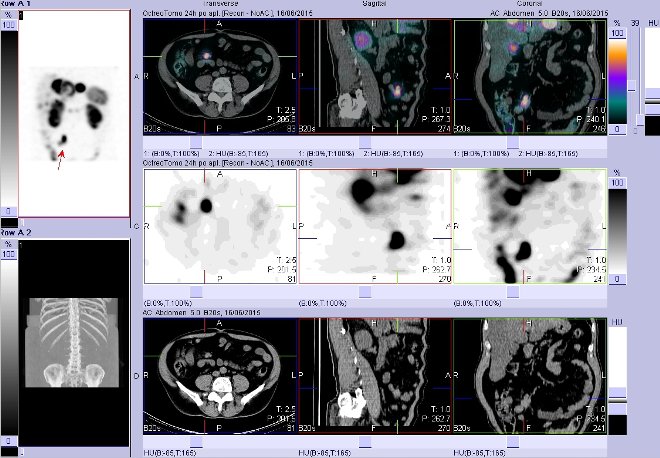 Obr. . 16: Fze obraz SPECT a CT  vyeten bicha. Vyeten 24 hod. po aplikaci radiofarmaka. Vpravo nahoe fze SPECT a CT, vlevo uprosted SPECT, vlevo dole CT. Zameno na loisko vpravm mesogastriu.