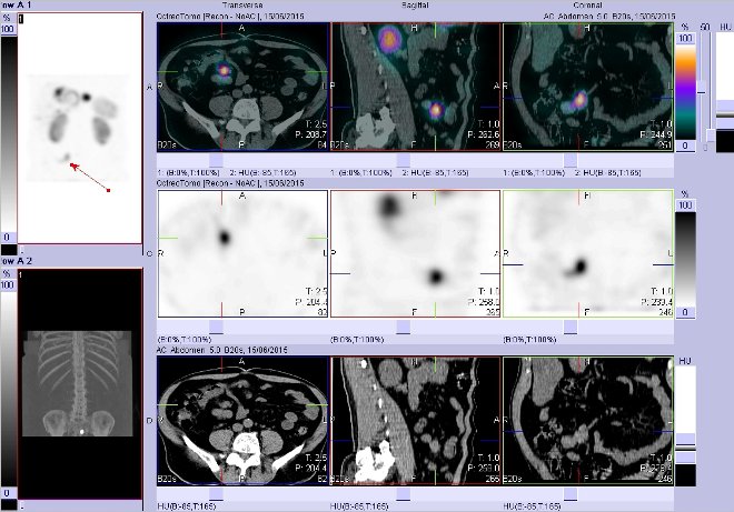Obr. . 6: Fze obraz SPECT a CT  vyeten bicha. Vyeten 4 hod. po aplikaci radiofarmaka. Vpravo nahoe fze SPECT a CT, vlevo uprosted SPECT, vlevo dole CT. Zameno na loisko v pravm mesogastriu.