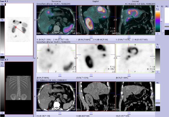 Obr. . 7: Fze obraz SPECT a CT  vyeten bicha. Vyeten 4 hod. po aplikaci radiofarmaka. Vpravo nahoe fze SPECT a CT, vlevo uprosted SPECT, vlevo dole CT. Zameno na loisko v pravm jaternm laloku.
