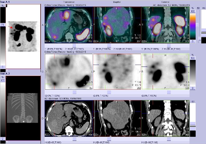 Obr. . 9: Fze obraz SPECT a CT  vyeten bicha. Vyeten 4 hod. po aplikaci radiofarmaka. Vpravo nahoe fze SPECT a CT, vlevo uprosted SPECT, vlevo dole CT. Zameno na loisko v pravm jaternm laloku.