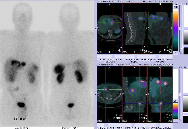 Obr.1: Celotlov scintigrafie vpedn a zadn projekci a fze obraz SPECT a CT. Vyeten 5 hod. po aplikaci radioindiktoru. Vpravo nahoe zameno na loisko vlevm jaternm laloku, vpravo dole zameno na loisko vpravm mesogastriu.