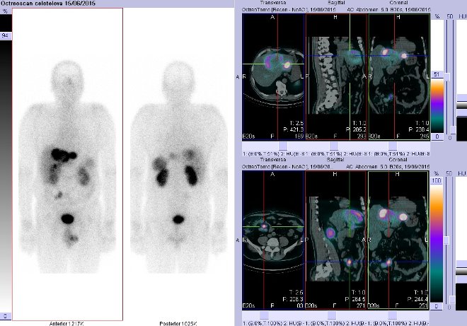 Obr. . 4: Celotlov scintigrafie v pedn a zadn projekci a fze obraz SPECT a CT. Vyeten 4 hod. po aplikaci radioindiktoru. Vpravo nahoe zameno na loisko v pravm jaternm laloku, vpravo dole zameno na loisko v pravm mesogastriu.