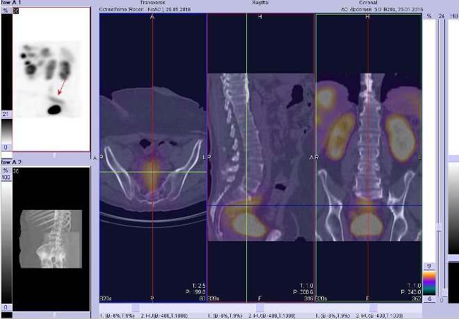 Obr. . 4: Fze obraz SPECT a CT. Zameno na prothl loisko uloen presakrln. ez transverzln, sagitln a koronrn. Vyeten 4 hod. po aplikaci OctreoScanu.
