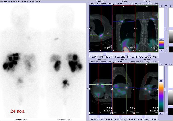 Obr. . 5: Celotlov scintigrafie a fze obraz SPECT a CT. Vpravo nahoe zameno na loisko vdorzln sti 4. ebra vlevo a vpravo dole na loisko ve ventrln sti pravho jaternho laloku. ez transverzln, sagitln a koronrn. Vyeten 24 hod. po aplikaci OctreoScanu.