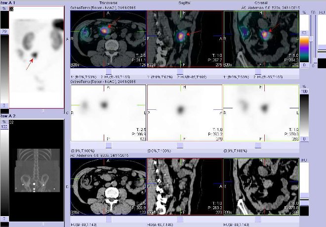 Obr. . 6: SPECT, CT a fze obraz SPECT a CT. Vyeten 24 hod. po aplikaci radioindiktoru. Nahoe fze obraz, uprosted obrazy SPECT, dole obrazy CT, vdy vlevo transverzln  ezy, uprosted sagitln ezy, vpravo ezy koronrn. Zameno na loisko v bie vpravm mesogastriu.