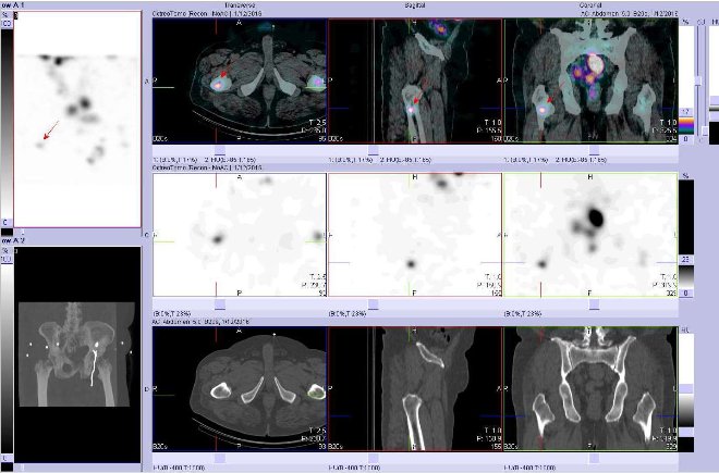 Obr. . 10: Fze obraz SPECT a CT. Vyeten 24 hod. po aplikaci radiofarmaka. Nahoe fze obraz, uprosted SPECT, dole CT. Vdy nad sebou: vlevo transverzln ezy, uprosted sagitln ezy, vpravo koronrn. Zameno na loisko v prav stehenn kosti.