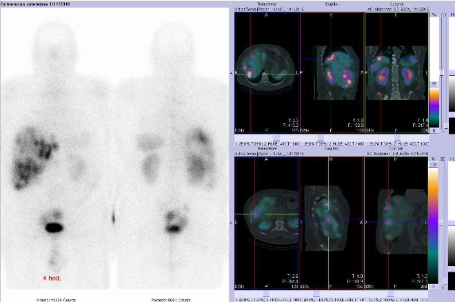 Obr. . 5: Celotlov scintigrafie v pedn a zadn projekci a fze obraz SPECT/CT. Vpravo nahoe zameno na loisko v dorzokraniln sti pravho jaternho laloku a vpravo dole na loisko v laterln sti pravho jaternho laloku. Vyeten 4 hod. po aplikaci radioindiktoru.