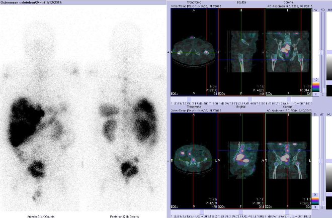 Obr. . 7: Celotlov scintigrafie v pedn a zadn projekci a fze obraz SPECT/CT. Vpravo nahoe zameno na loisko v lev stehenn kosti a vpravo dole na loisko v bedernm obratli. Vyeten 24 hod. po aplikaci radioindiktoru.