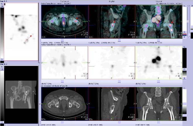 Obr. . 8: Fze obraz SPECT a CT. Vyeten 24 hod. po aplikaci radiofarmaka. Nahoe fze obraz, uprosted SPECT, dole CT. Vdy nad sebou: vlevo transverzln ezy, uprosted sagitln ezy, vpravo koronrn. Zameno na loisko v lev stehenn kosti.