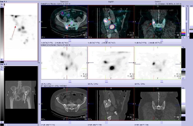Obr. . 9: Fze obraz SPECT a CT  zameno na loisko vpnvi vpravo. Vyeten 24 hod. po aplikaci radiofarmaka. Nahoe fze obraz, uprosted SPECT, dole CT. Vdy nad sebou: vlevo transverzln ezy, uprosted sagitln ezy, vpravo koronrn.