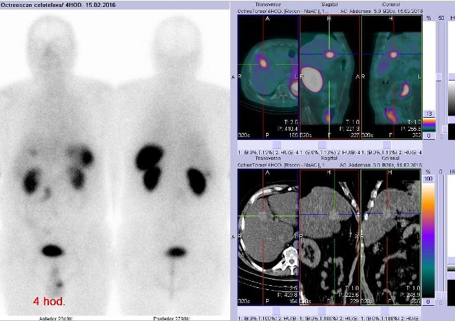 Obr. . 2: Celotlov scintigrafie vpedn a zadn projekci a fze SPECT/CT 4 hod. po aplikaci OctreoScanu. Zameno na loisko ve ventrln sti pravho jaternho laloku.