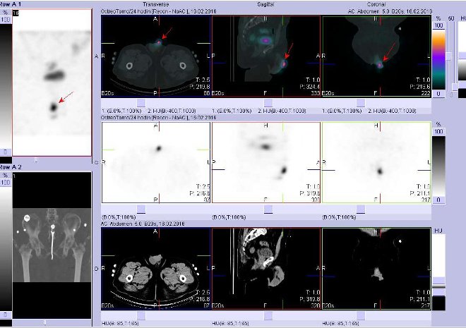 Obr. . 7: Fze obraz SPECT a CT. Zameno na okrsek kontaminace. Nahoe fze obraz, uprosted SPECT, dole CT. Vyeten 24 hod. po aplikaci OctreoScanu.