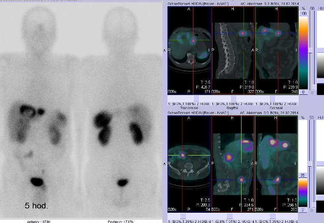 Obr.. 1: Celotlov scintigrafie vpedn a zadn projekci a fze obraz SPECT a CT. Vyeten 5 hod. po aplikaci radioindiktoru. Vpravo nahoe zameno na loisko vlevm jaternm laloku, vpravo dole zameno na loisko vpravm mesogastriu.