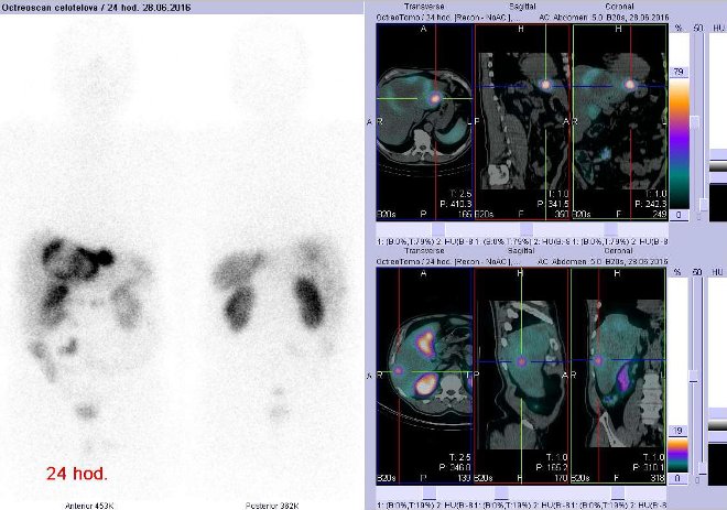 Obr. . 10: Celotlov scintigrafie vpedn a zadn projekci a fze obraz SPECT a CT. Vyeten 24 hod. po aplikaci radioindiktoru. Vpravo nahoe zameno na loisko vlevm jaternm laloku, vpravo dole zameno na loisko vpravm jaternm laloku.