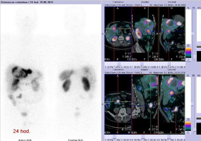 Obr. . 11: Celotlov scintigrafie v pedn a zadn projekci a fze obraz SPECT a CT. Vyeten 24 hod. po aplikaci radioindiktoru. Vpravo nahoe zameno na loisko v pravm jaternm laloku, vpravo dole zameno na loisko v pravm mesogastriu.
