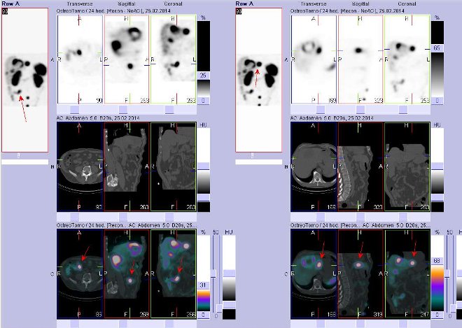 Obr. . 2: Fze obraz SPECT a CT  vyeten bicha. Vyeten 24 hod. po aplikaci radiofarmaka. Vlevo nahoe SPECT, vlevo uprosted CT, vlevo dole fze obraz, zameno na loisko vpravm mesogastriu. Vpravo nahoe SPECT, vpravo uprosted CT, vpravo dole fze obraz, zameno na loisko vlevm jaternm laloku.