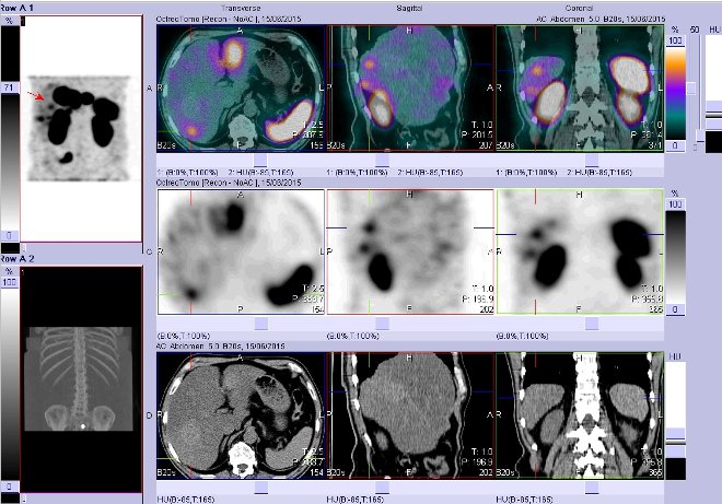 Obr. . 4: Fze obraz SPECT a CT  vyeten bicha. Vyeten 4 hod. po aplikaci radiofarmaka. Vpravo nahoe fze SPECT a CT, vlevo uprosted SPECT, vlevo dole CT. Zameno na loisko v pravm jaternm laloku.
