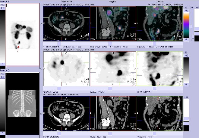 Obr. . 8: Fze obraz SPECT a CT  vyeten bicha. Vyeten 24 hod. po aplikaci radiofarmaka. Vpravo nahoe fze SPECT a CT, vlevo uprosted SPECT, vlevo dole CT. Zameno na loisko vpravm mesogastriu.
