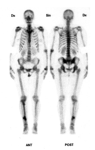 Obrázek č.l: Celotělový sken kostí po i. v. aplikaci 99mTc HDP
