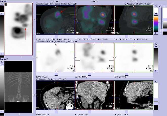 Obr. . 6: Fze obraz SPECT a CT. Vyeten 5 hod. po aplikaci radioindiktoru. Zameno na loisko ve ventrokaudln sti pravho jaternho laloku.