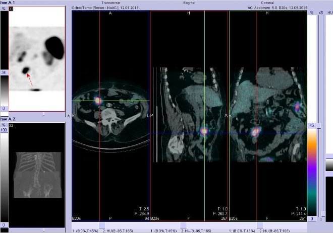 Obr..2: Fze obraz SPECT a CT  vyeten bicha. Vyeten 4 hod. po aplikaci radiofarmaka. Vlevo transverzln ez, uprosted sagitln ez, vpravo koronrn. Zameno na loisko vpravm mesogastriu.