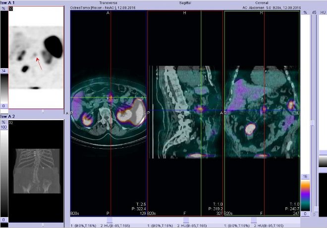 Obr.3: Fze obraz SPECT a CT  vyeten bicha. Vyeten 4 hod. po aplikaci radiofarmaka. Vlevo ez  transverzln, uprosted sagitln, vpravo koronrn. Zameno na loisko v epigastriu.