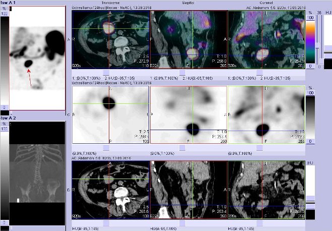 Obr. . 6: Fze obraz SPECT a CT  vyeten bicha. Vyeten 24 hod. po aplikaci radiofarmaka. Nahoe fze obraz, uprosted SPECT, dole CT. Vdy nad sebou: vlevo transverzln ezy, uprosted sagitln ezy, vpravo koronrn. Zameno na loisko vpravm mesogastriu.