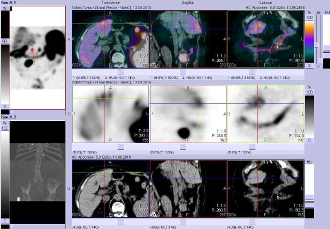 Obr. . 8: Fze obraz SPECT a CT  vyeten bicha. Vyeten 24 hod. po aplikaci radiofarmaka. Nahoe fze obraz, uprosted SPECT, dole CT. Vdy nad sebou: vlevo transverzln ezy, uprosted sagitln ezy, vpravo koronrn. Zameno na loisko v levm jaternm laloku.