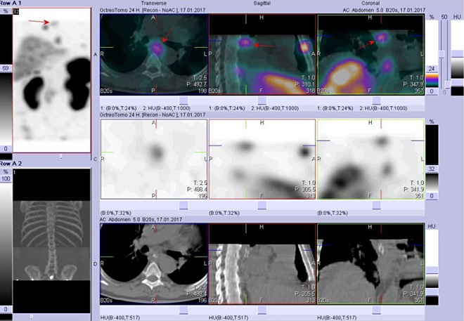 Obr. . 7: Vpravo nahoe fze SPECT a CT, vpravo uprosted SPECT, vpravo dole CT.
