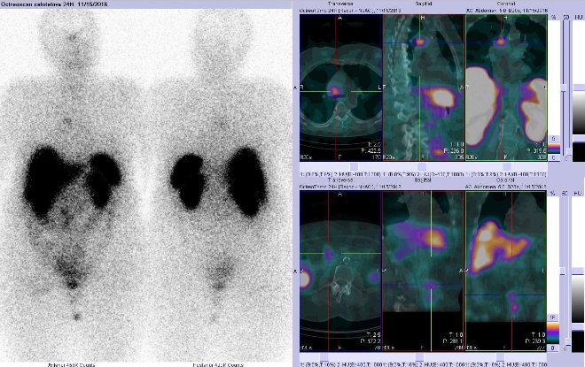 Obr. . 5: Celotlov scintigrafie v pedn a zadn projekci a fze SPECT/CT 24 hod. po aplikaci OctreoScanu. Zameno na loisko v hrudnku tsn vpravo od stedn ry.