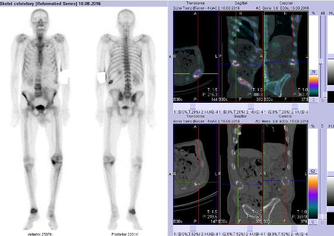 Obr. . 1: Celotlov scintigrafie v pedn a zadn projekci a fze obraz SPECT a CT. Vpravo fze obraz SPECT a CT - zameno na loisko v 11. ebru vlevo. ezy transverzln, sagitln a koronln.