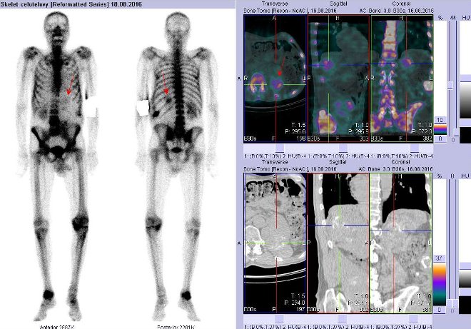 Obr. . 2: Celotlov scintigrafie vpedn a zadn projekci a fze obraz SPECT a CT. Vpravo fze obraz SPECT a CT - zameno na ndorovou recidivu vlku po levostrann nefrektomii. ezy transverzln, sagitln a koronln.