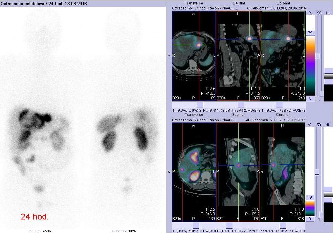 Obr. . 2: Celotlov scintigrafie v pedn a zadn projekci a fze obraz SPECT a CT. Vyeten 24 hod. po aplikaci radioindiktoru. Vpravo nahoe zameno na loisko v levm jaternm laloku, vpravo dole zameno na loisko v pravm jaternm laloku.