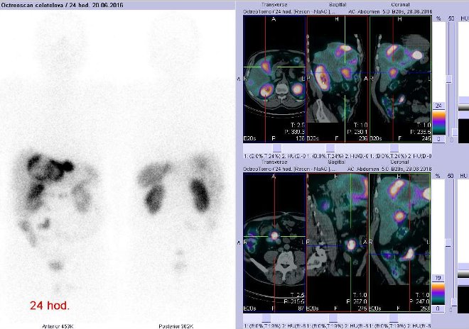 Obr. . 3: Celotlov scintigrafie vpedn a zadn projekci a fze obraz SPECT a CT. Vyeten 24 hod. po aplikaci radioindiktoru. Vpravo nahoe zameno na loisko vpravm jaternm laloku, vpravo dole zameno na loisko vpravm mesogastriu.