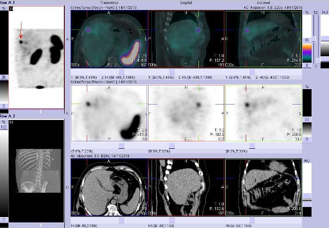 Obr. . 2: Fze obraz SPECT a CT. Vyeten 5 hod. po aplikaci radioindiktoru. Zameno na loisko ve ventrolaterln sti pravho jaternho laloku.
