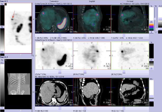 Obr. . 3: Fze obraz SPECT a CT. Vyeten 24 hod. po aplikaci radioindiktoru. Zameno na loisko ve ventrolaterln sti pravho jaternho laloku.