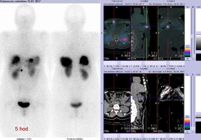 Obr.1: Celotlov scintigrafie v pedn a zadn projekci a fze obraz SPECT a CT. Vyeten 5 hod. po aplikaci radioindiktoru. Vpravo zameno na loisko povrchov v bin stn vpravo.