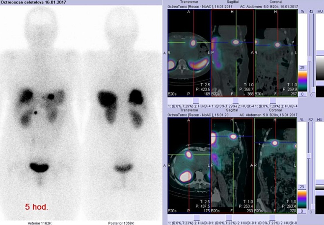 Obr..2: Celotlov scintigrafie v pedn a zadn projekci a fze obraz SPECT a CT. Vyeten 5 hod. po aplikaci radioindiktoru. Vpravo nahoe zameno na loisko v levm jaternm laloku, vpravo dole zameno na loisko v pravm laloku ventrokraniln.