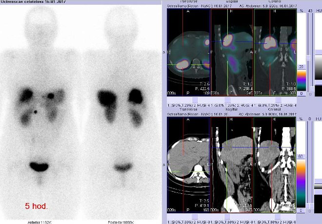 Obr.3: Celotlov scintigrafie v pedn a zadn projekci a fze obraz SPECT a CT. Vyeten 5 hod. po aplikaci radioindiktoru. Vpravo zameno na loisko v pravm laloku dorzln.