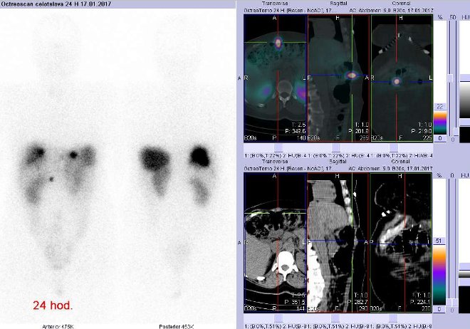 Obr. . 5: Celotlov scintigrafie v pedn a zadn projekci a fze obraz SPECT a CT. Vyeten 24 hod. po aplikaci radioindiktoru. Vpravo zameno na loisko povrchov v bin stn vpravo.